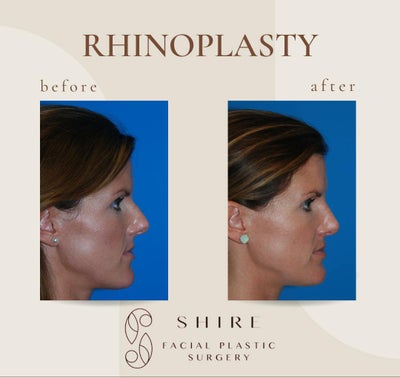 Rhinoplasty before and after photo
