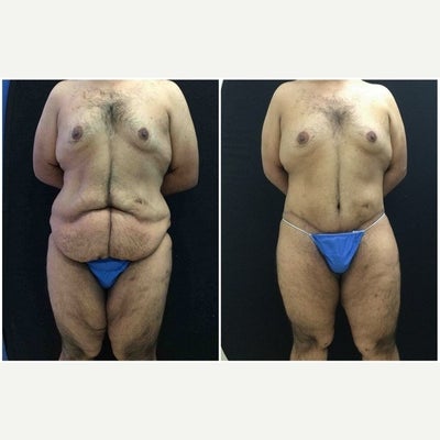 Body Lift before and after photo