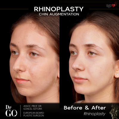 Rhinoplasty before and after photo