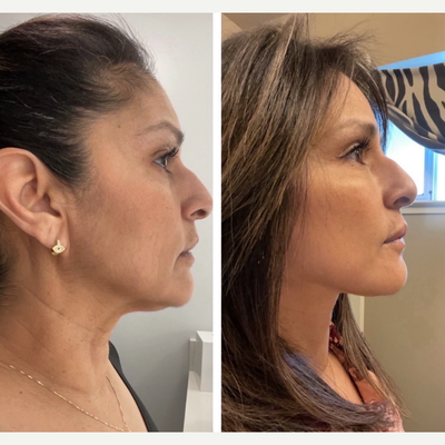 Mini Facelift before and after photo