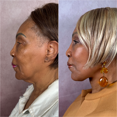 Facial Fat Transfer before and after photo