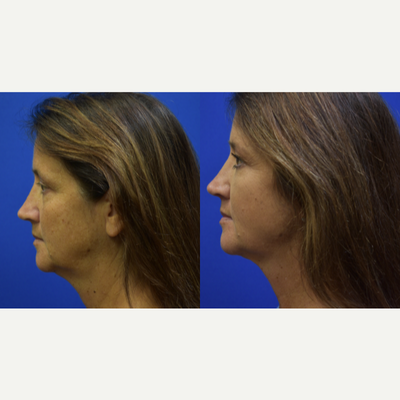 FaceTite before and after photo