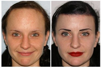 Hair Transplant before and after photo