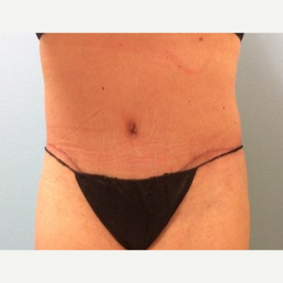 What To Expect During Recovery From Tummy Tuck Surgery – The Gill