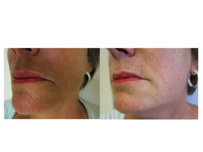 Radiesse before and after photo