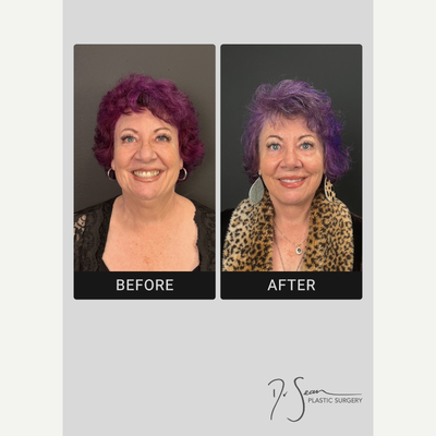 Facelift before and after photo