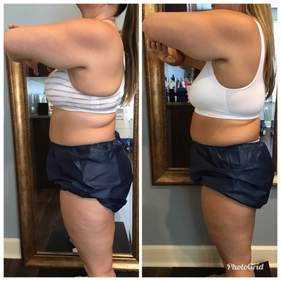 CoolSculpting before and after photo