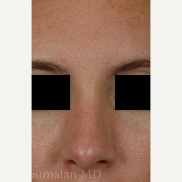 Dr. Richard Zoumalan, Top Nose Job Doctor and Surgeon in CA, Best Natural  Ethnic Rhinoplasty and Septoplasty Surgery LA, Buccal Fat Removal, Chin  Implant, Non-Surgical Facelift and Necklift Specialist with Good Results