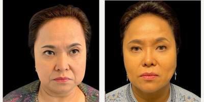 55-64 year old woman treated with Nonsurgical Facelift, Renuvion for Facial Resurfacing - Patient: Female, 59Procedure: Renuvion Mini FaceliftRecovery: 9 months