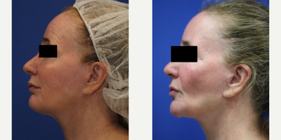 55-64 year old woman treated with Silicone Injection Removal - Meet our resilient patient, a 55-year-old white female standing at 5'1 and weighing 117 pounds. She had silicone injected into her face and unfortunately experienced numerous health issues as a result. Concerned for her wellbeing, she turned to the renowned Dr. J. Timothy Katzen in Beverly Hills, CA, for help.Dr. Katzen skillfully removed the silicone from her face, providing her with much-needed relief. Our patient now feels much better and is grateful for the compassionate care she received. Her journey is a reminder of the importance of seeking out qualified professionals when considering cosmetic procedures and the potential dangers of unregulated treatments.
