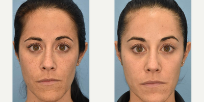 Woman treated with Fraxel Laser - Woman treated with Fraxel Laser.