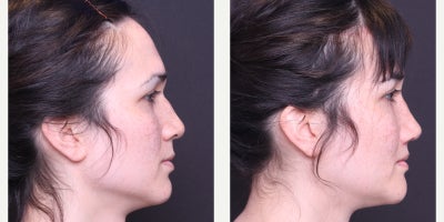 25-34 year old transgender woman treated with Facial Feminization Surgery, Adam's Apple Reduction - Thyroplasty, AFG to Face, Browbone Reduction, Browlift, Hairline Advancement, Rhinoplasty, Liplift, Mandible/Chin Contouring, Sliding Genioplasty, Submental Liposuction