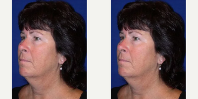 Woman treated with Brow Lift - Woman treated with Brow Lift