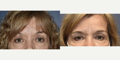 45-54 year old woman treated with Eyelid Surgery - 50 year old female undergoing upper eyelift