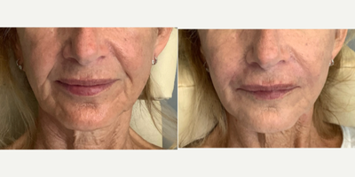 65-74 year old woman treated with Chin Filler, Dermal Fillers, Juvederm, Restylane Lyft, Restylane, Revanesse, Voluma - 68 year old female improving the wrinkles and jowls in the lower part of the face.   She received a Juvederm Voluma deep in the chin and jowl areas with a 25g cannula   Then a medium thickness filler (Lyft) in the nasolabial lines.   Then a light filler (Restylane) to soften the superficial lines around the mouth using a 30g cannula.  It's an artistic approach using layering and sequencing to create a natural results with no downtime.