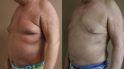 55-64 year old man treated with Gynecomastia Surgery - This gentleman presented for correction of a previously performed gynecomastia surgery after which he had residual breast tissue and indentations from over-aggressive liposuction above the breast gland. This was corrected with revision gynecomastia surgery including ultrasound assisted liposuction and J plasma skin tightening. At three months post-operative he has amazing results.
