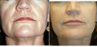 55-64 year old woman treated with ProFractional Laser followed with Thermage - ProFractional and Thermage.
