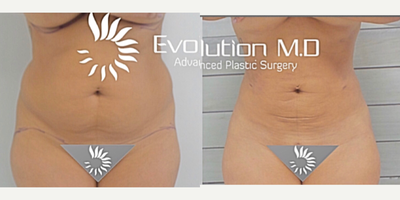 25-34 year old woman treated with Slim Lipo - 25-34 year old woman treated with Slim Lipo