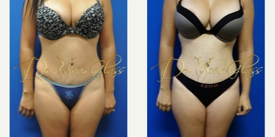 Tummy Tuck Revision - She wanted a correction from her tummy tuck intervention before so she underwent an hourglass tummy tuck revision.
