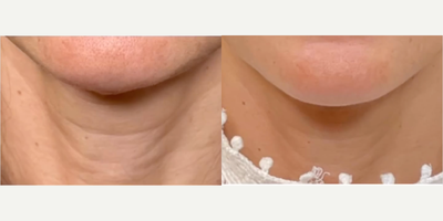 Woman treated with Renuva - Woman treated with Renuva