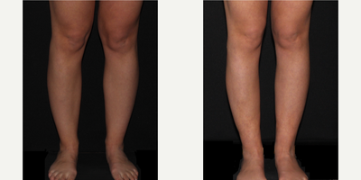 25-34 year old woman treated with Calf Reduction - Before and after knee, calf and ankle liposuction.