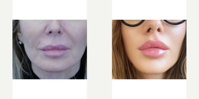65-74 year old woman treated with Lip Lift - This patient is an ideal lip lift candidate where she has already voluminous lips but a longer skin part of the upper lip. Postoperative selfie photo at 7 weeks demonstrates sexy lip proportions.