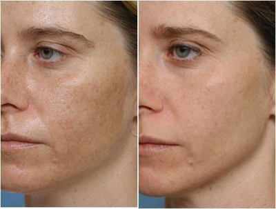 TCA peel - 	This patient wanted to diminsh the brown spots she had throughout her face. She had a 35% TCA chemical peel. Results show dimished brown spots and refreshed skin.