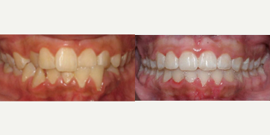 25-34 year old woman treated with Damon Braces - Damon Braces Treatment