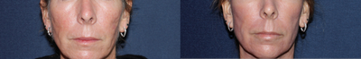 Fraxel Repair - 
	Fraxel Repair
