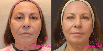65-74 year old woman treated with Skin Lightening - Our lovely 65-year-old patient wanted to improve the appearance of her face. She was bothered by deep wrinkles and discoloration. We performed Resurfacing Perfected using our Sciton laser for her and are as thrilled with her result as she is.
