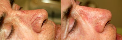 VeinGogh for Removal of Spider Veins on Nose - 	Treatment of spider veins on nose with VeinGogh.