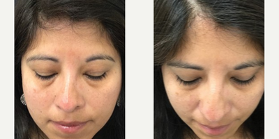 Woman treated with TempSure Envi - Woman treated with TempSure Envi to under eyes to get rid of puffiness and dark circles, shown 2 months post op.