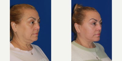 55-64 year old woman treated with Deep Plane Facelift, Neck Lift - 55-64 year old woman treated with Deep Plane Facelift, Neck Lift