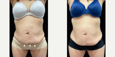 Woman treated with SculpSure - Woman treated with SculpSure