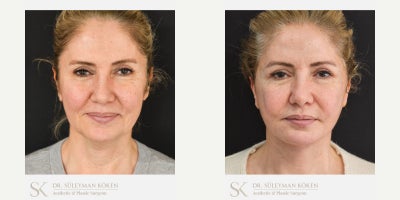45-54 year old woman treated with Deep Plane Facelift, Chin Liposuction, Facial Fat Transfer - Deep plane full face and neck liftChin LiposuctionNasolabial fat transfer