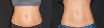 CoolSculpting - 	Patient had CoolSculpting procedure to abdomen.