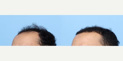 18-24 year old man treated with FUE Hair Transplant, PRP Injections - This 24-year-old patient was unhappy with his receding hairline. Dr. Wise performed an FUE hair transplant and one session of PRP therapy to achieve these results.