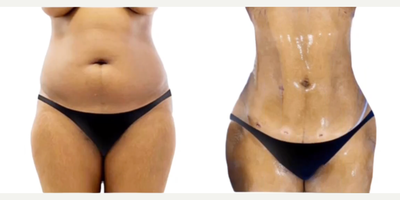 Woman treated with Lipo 360 - Woman treated with Lipo 360