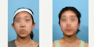 18-24 year old woman treated with Earfold - Six weeks post - otoplasty with Dr. Wise in New Jersey, this 18-year-old patient is very happy her ears no longer stick out. She also noted that the recovery was much easier than she had anticipated.