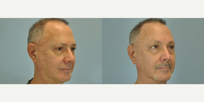 66 year old man treated with Mole Removal - This 66 year old was treated with Mole Removal.