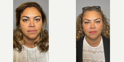 45-54 year old woman treated with Dermal Fillers, Restylane, Dysport, Nonsurgical Facelift - Nonsurgical facelift-fillers.