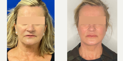 65-74 year old woman treated with Mini Facelift, Neck Lift - 66 year old woman treated with Mini Facelift, Neck Lift
