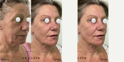 45-54 year old woman treated with Nonsurgical Facelift, Silhouette Soft, Collagen Injection, Ellanse - Non Surgical facelift with Collagen Stimulators