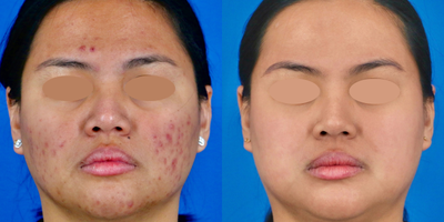 25-34 year old woman treated with Accutane, IPL, Skin Tightening, Skin Rejuvenation, Chemical Peel, Microneedling - Our patient underwent a comprehensive skincare journey, including treatment with baby-dose isotretinoin, M22 laser treatments, chemical peel, medical grade skincare, and microneedling to achieve healthy, rejuvenated skin. This personalized regimen was carefully designed to address various skin concerns, resulting in a transformative experience that enhanced her skin's texture, tone, and overall appearance.