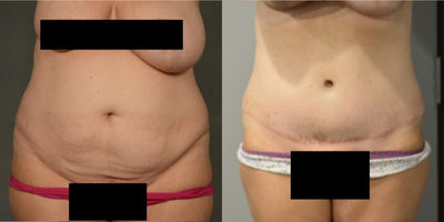 35-44 year old woman treated with Tummy Tuck - 1697 grams removed