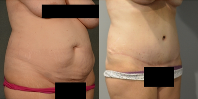 35-44 year old woman treated with Tummy Tuck - 1697 grams removed