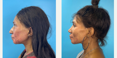 45-54 year old woman treated with African American Rhinoplasty - A woman is shown 3 1/2 months following a Rhinoplasty to improve nasal asymmetry, reduce a dorsal hump, prevent drooping of her nasal tip when smiling, and provide further tip refinement with the overall goal of maintaining a natural result.  Please note how her profile is improved and the tip of her nose no longer droops when she smiles.Approximately 80% of the swelling has resolved at this point.  The remainder will take up to a year, sometimes longer depending on multiple factors, such as skin thickness.  This patient's skin thickness is thicker than most, and so she may continue to notice improvement in swelling well after a year postoperatively... Key maneuvers in this patient included a hump reduction, angulated caudal septal trim, spreader grafts, a columellar strut, alar contour grafts, and further grafting of the nasal tip with soft tissue... The multiple cartilage grafts were used to help provide long-term stability and structure to maintain the aesthetic and functional goals.