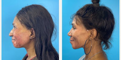 45-54 year old woman treated with African American Rhinoplasty - A woman is shown 3 1/2 months following a Rhinoplasty to improve nasal asymmetry, reduce a dorsal hump, prevent drooping of her nasal tip when smiling, and provide further tip refinement with the overall goal of maintaining a natural result.  Please note how her profile is improved and the tip of her nose NO LONGER DROOPS when she smiles.Approximately 80% of the swelling has resolved at this point.  The remainder will take up to a year, sometimes longer depending on multiple factors, such as skin thickness.  This patient's skin thickness is thicker than most, and so she may continue to notice improvement in swelling well after a year postoperatively... Key maneuvers in this patient included a hump reduction, angulated caudal septal trim, spreader grafts, a columellar strut, alar contour grafts, and further grafting of the nasal tip with soft tissue... The multiple cartilage grafts were used to help provide long-term stability and structure to maintain the aesthetic and functional goals.
