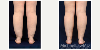 25-34 year old woman treated with Calf Reduction - Lower leg liposcution