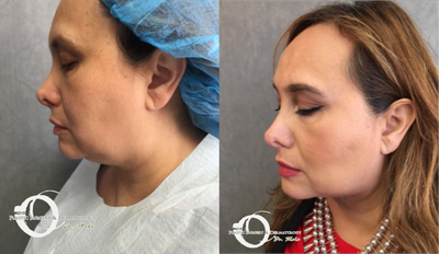 35-44 year old woman treated with Chin Liposuction - chin lipo